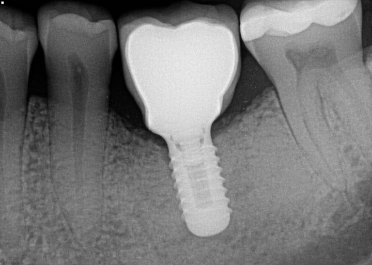 Implant x-ray – Sonrisa Dental