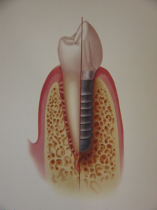 Dental Implants in Logan Square